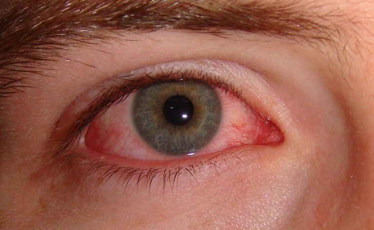 Best Eye Drops For Red Eyes, For Effective Redness Relief!