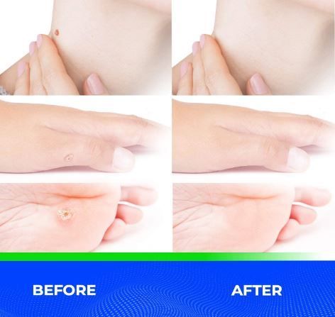 Best Wart Removal Treatment to Prevent Warts From Spreading!